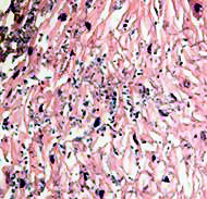 Candidiasis